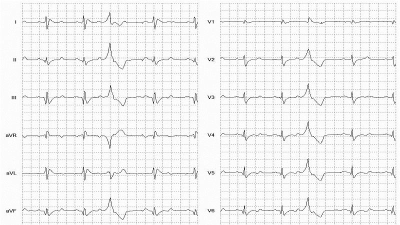 VEB Right Bundle Branch Morphology 12 Lead EKG